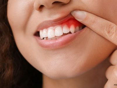 Gum Surgeries