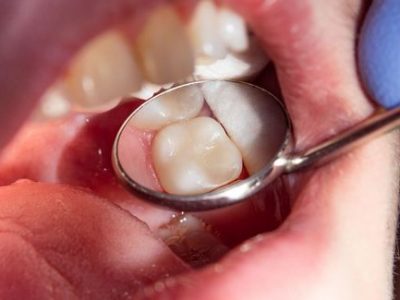 Cavity Fillings